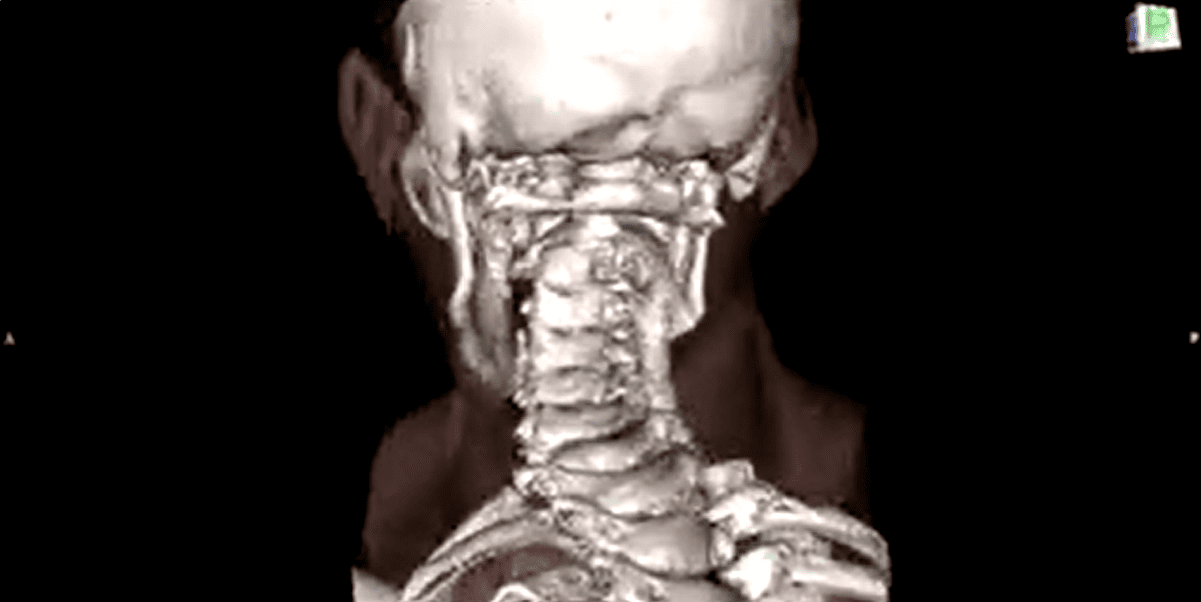 étage cervical supérieur